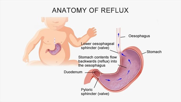 What is Acid Reflux