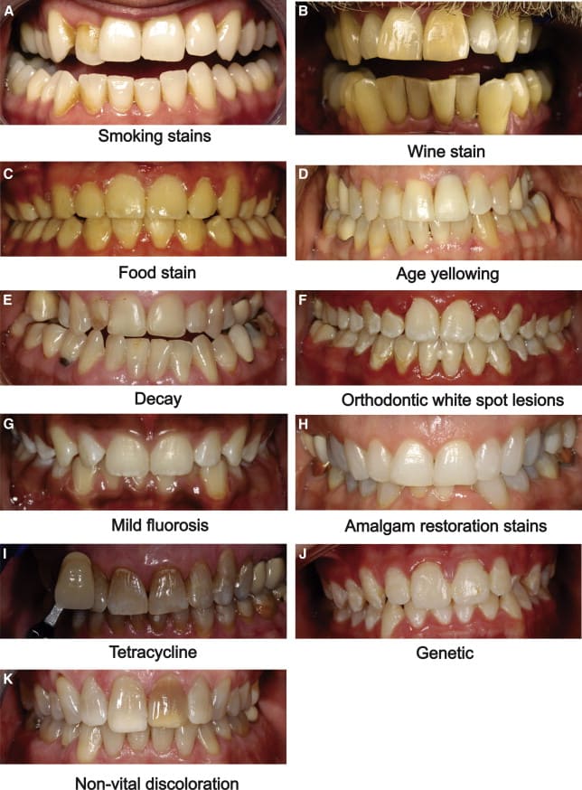 Different stains on teeth