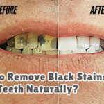 How to Remove Black Stains from Teeth Naturally