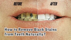 How to Remove Black Stains from Teeth Naturally