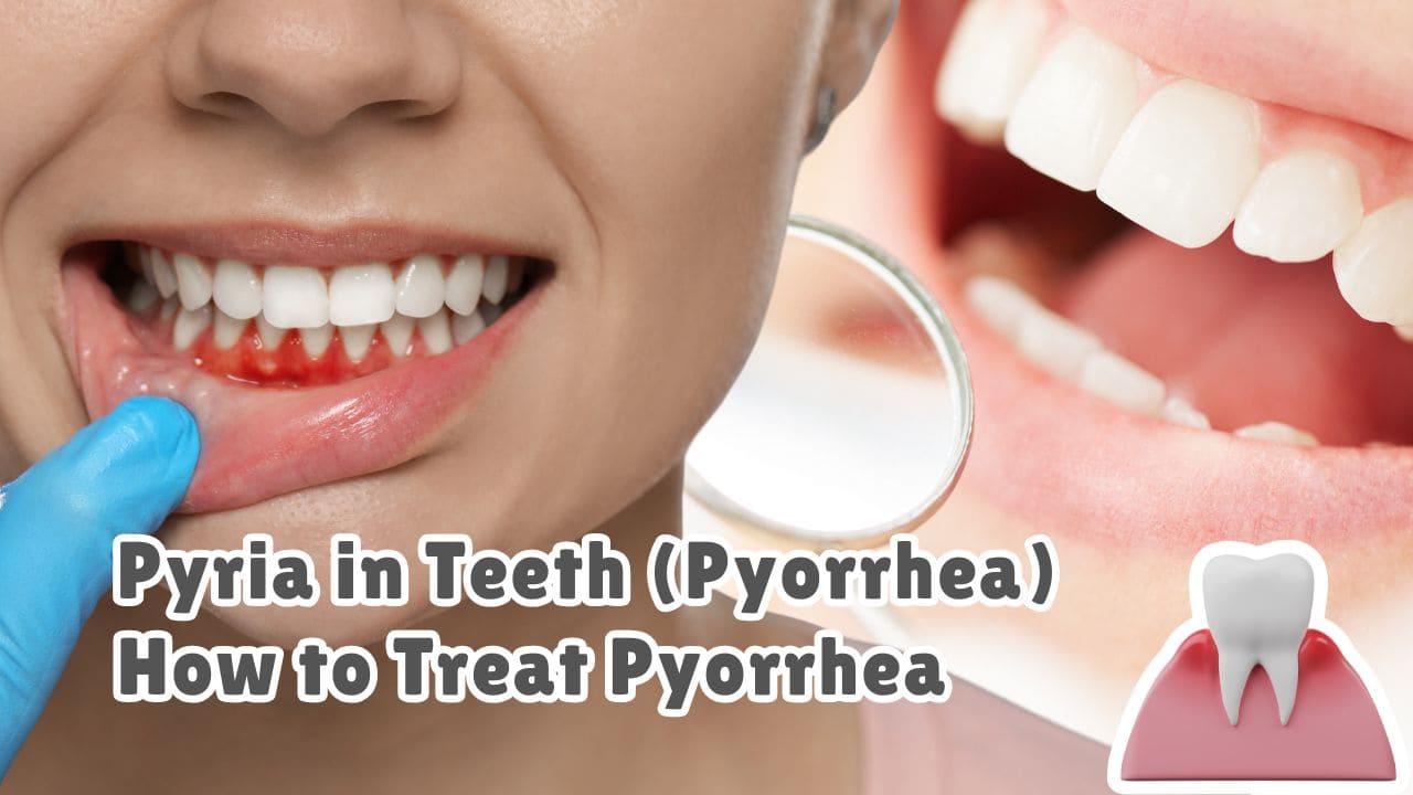 Pyria in Teeth (Pyorrhea) How to Cure Pyria from teeth