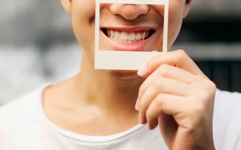 Removing Black stains from teeth